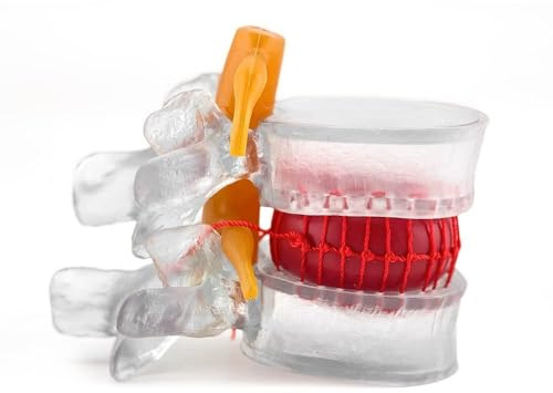 Transparent Mänsklig Anatomisk Modell For Diskbråck I Ländryggen, Modell For Medicinsk Vetenskap, Ryggradsmodell, 1,5 X Naturlig Storlek For Ryggradsryggradsskivor For Inlärning Och Undervisning
