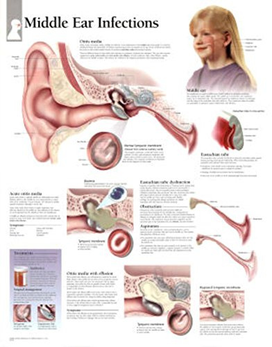 Middle Ear Infection chart: Wall Chart