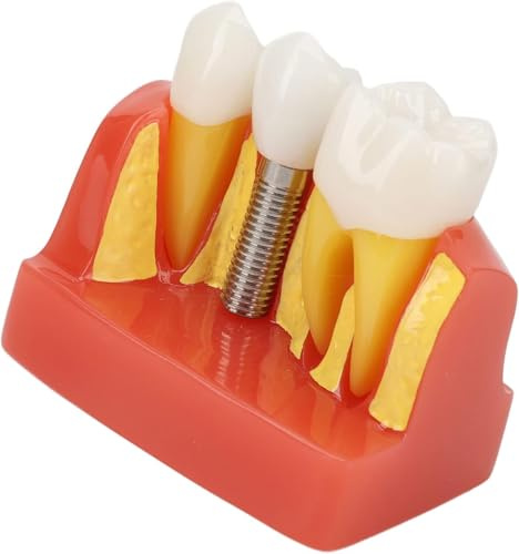 UIGJIOG Modèle D'implant Dentaire Orthodontic Treatment Résine Modèle D'implant Dentaire L'éducation Patients,Modèle Couronne Et De Pont L'éducation Communication avec Les Patients Laboratoire