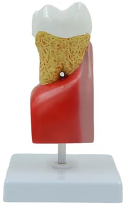 XqmarT Modello ingrandito di Cura dei Denti Umani Carie Dentale Forniture mediche per Studenti Risorse didattiche Modello anatomico