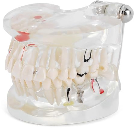 Namvo Dental Implant Study Modell, Vuxna Transparent Tandmodell för Utbildning i Patologiska Tillstånd med avtagbara tänder, Perfekt för Tandundervisning