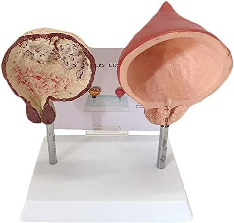 Medizinisches Anatomisches Blasenmodell Vergleichsmodell Der Rauchblase Und Der Normalen Blase Anatomiemodell des Menschlichen Organs Modell des Menschlichen Harnsystems Modell Für Die Stud