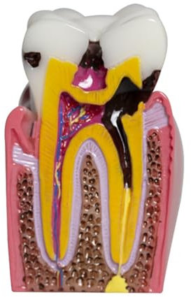 BURLOE Zahnanatomie Modell, Aus Harz Für Die Mundpflege Im Dentallabor Zahn Karies Vergleich Studienmodelle Zahnarzt Aufklärungszahnmodell,Weiß