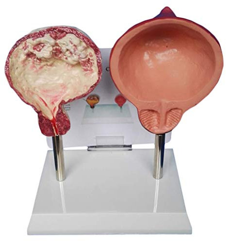 Anatomisches Modell des menschlichen Organs EIN Vergleichsmodell von Rauchblase und normaler Blase, medizinisches Blasenmodell