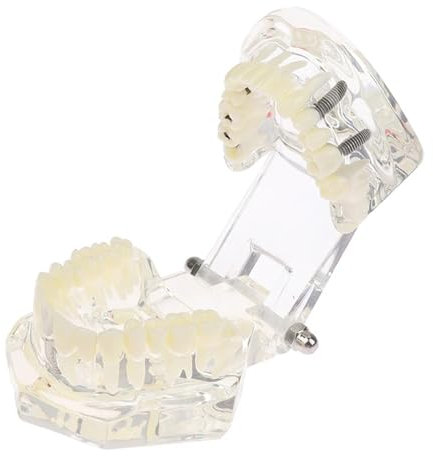 ERNZI Modèle Dentaire des Dents De Dents Restoration Bridge Prime Prime pour Étude Science des Dents