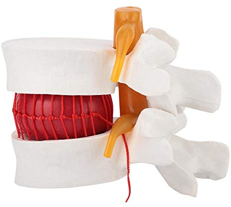LiebeWH Plastic Human Lumbar Disc Herniation Medical Demonstration Model, 1: 1.5 Model of Lumbar Vertebral Spine Human Lumbar Disc Model for Linical Teaching