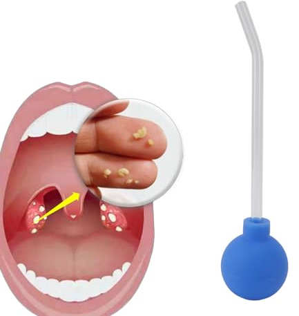 Tonsil stenborttagningssats, tonsil stenborttagare dammsugare tonsil sten koppverktyg PVC sugboll dålig andedräkt borttagning hals sugtub munrengörare (blå)