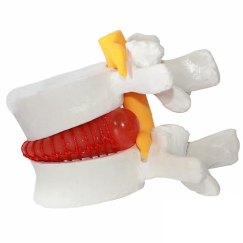 Huraoerrrr Lumbar Disc Herniation Model 1.5 Times Life Size Spine Model Portable Anatomical Human Lumbar Spine for Medical, Teaching, Learning and Scientific Presentations