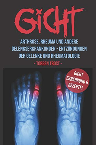 Gicht Arthrose, Rheuma, und andere Gelenkserkrankungen – Entzündungen der Gelenke und Rheumatologie Gicht Ernährung und Rezepte