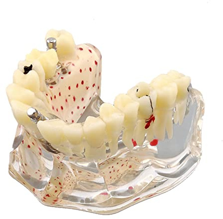 Dental Upper Implantate Modell - Upper Overdenture Restauration Modell - mit überlegenen Zähnen Demo Transparent Vision, Soft Gum, Implant Nagel, für Bildung und Studium Modell Werkzeug (B)