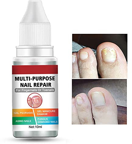 Fungal Nail Treatment for Toenail Extra Strong, Multi-purpose Nail Repair Lotion for Fingernails Toenails, Toe Nail Fungal Treatment Fixes Discolored Nails Safe Effective(10ML Red)