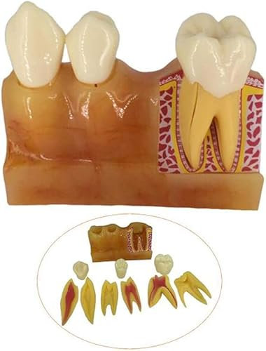 ERNZI Bildungsmodell Zähne Kaugummi Anatomisches Modell Zähne Zahnfleisch Mundes Modell Harz Zähne Zahnfleisch Zahnpflege Lehr Endodontisches Modell Für Das Studienmodell