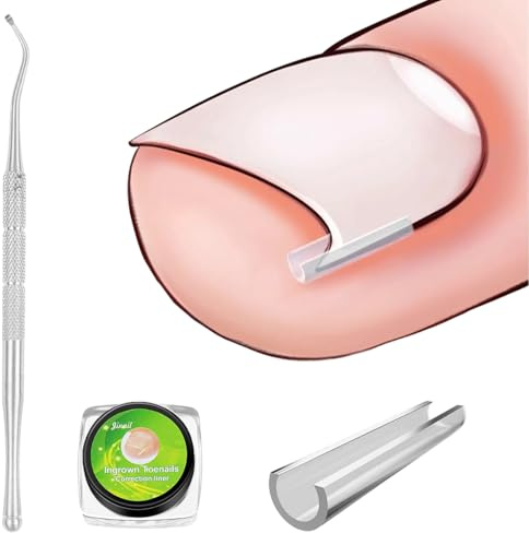 50 pezzi Set correttore per unghie incarnite, Strisce raddrizzanti per unghie incarnite senza dolore con sollevatore per unghie, Kit di strumenti per unghie incarnite facili da usare