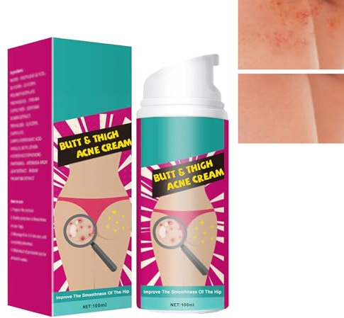 KOAHDE Akne-Reinigungscreme Für Gesäß Und Oberschenkel,Acne Creme Für Das Gesäß,Po-Akne-Creme,100ML,Po-Akne-Pickel-Reinigungscreme