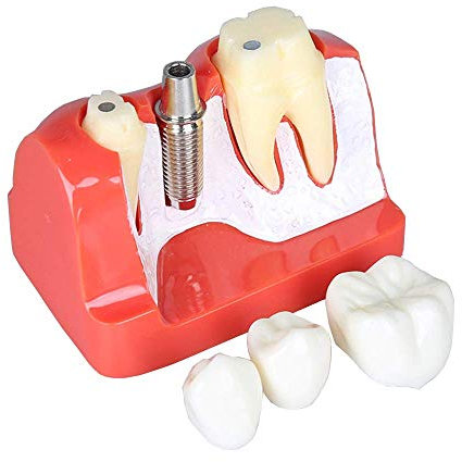 LBYLYH Modèles de Dents Modèle d'enseignement des implants dentaires Modèles de Dents Analyse des implants Crown Bridge pour de l'étude