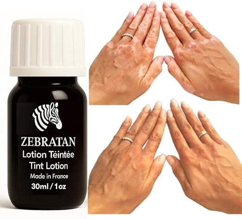 Trucco vitiligine su misura Zebratan - 30 ml Beige Marrone - Lozione autoabbronzante - non grassa, non un fondotinta - mimetico piastre