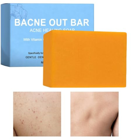 Bacne Out Bar, Nuovo Sapone Detergente Per L'acnes Corporea | Sapone Detergente Per L'acnes Del Corpo Con Curcuma, SaponeAlla Curcuma Per Il Trattamento Di Acnes Per L'acneDel Corpo