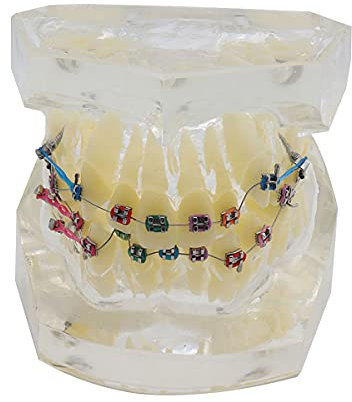 Zahnmedizinisches kieferorthopädisches Demonstrationsmodell, zahnmedizinisches Studienmodell, Zahnmodell mit mentalen Brackets, Simulationsmodell für kieferorthopädische Zähne mit Ligaturen,Weiß