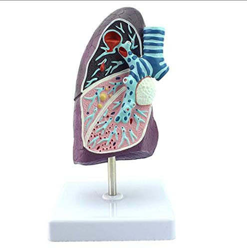 WEISSBIGR Lehrmodell, anatomisches Modell der pathologischen Tuberkulose-Pneumonie der menschlichen Lunge eines Rauchers für Arzt, Büro, Klassenzimmer, Patientenaufklärung