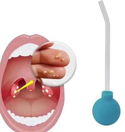 Herramienta Eliminadora De Piedras Amigdalinas Verde Con Bulbo Aspirador De PVC Y Tubo De Succión, Limpiador Bucal Para Garganta Elimina Mal Aliento, Dispositivo Ergonómico Portable De Mater