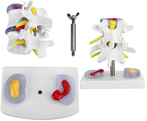 WEISSBIGR Lendenwirbelsäulenmodell, menschliches lumbales Bandscheibenvorfallmodell, anatomisches lumbales Bandscheibenvorfall-Demonstrationsmodell der menschlichen Wirbelsäule