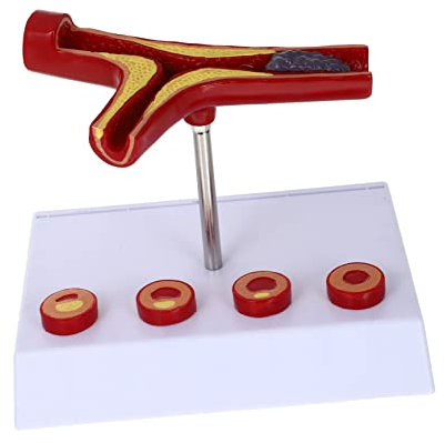 COSMEVIVI Herz Kreislauf Modell Aus Pvc Anatomisches Blutgefäßmodell Mit Thrombus Lehrreiches Krankenhausteil Für Physiologie Und Anatomiekurse