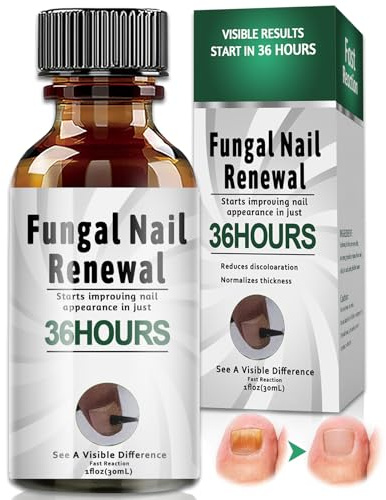 30 ml Tratamiento hongos uñas pies – Solución efectiva que combate la decoloración, antihongos para uñas fáciles de usar,Apoyo para el Cuidado Diario de Hombres y Mujeres