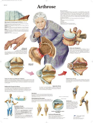3B Scientific Lehrtafel laminiert - Arthrose