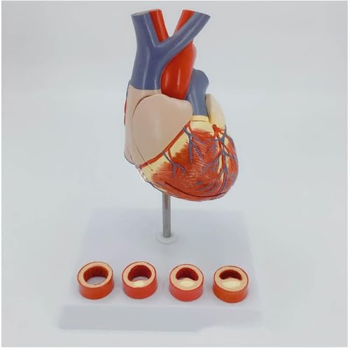 MOZ4dxy Anatomisches Modell des menschlichen Herzens mit Thrombus-vergrößertem Herzmodell, 1:1, lebensgroß, abnehmbares menschliches Herz, anatomisches Modell, Lehrwerkzeug