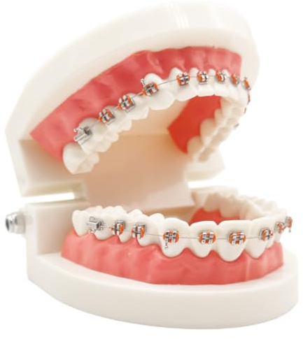 Easyinsmile Dental Orthodontic Teeth Model with Metal Bracket Tooth Model with Braces for Patients Communication