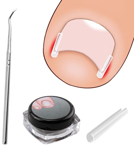 40 Strisce Raddrizzanti in Gel Senza Dolore con Sollevatore per Unghie, Correzione delle Unghie Incarnite, Kit Professionale per il Trattamento e la Prevenzione delle Unghie dei Piedi Incarnite