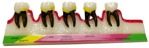 UPIKIT Enseignement De La Communication Médecin-Patient sur L'évolution De La Réparation Orthodontique des Nerfs À L'aide d'un Modèle Dentaire Et d'un Bridge