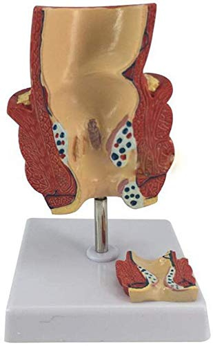 El Modelo Las Hemorroides Patológicas Humanas, El Modelo, La Hmorraidenlsion Colorrectal, Es La Mejor Ayuda Docente Para La Comunicación.