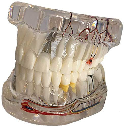 LBYLYH Marques Education Modèle Dentaire Modèle de Dents d'implant avec Dentiste de Restaurant Bridge pour la médecine Science maladie enseignement