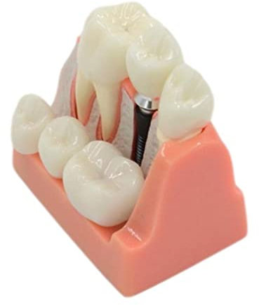 ERNZI Modèle De Dents Flexibles Modèle Implant Dentaire pour Étudier Enseignement pour La Science Implant Dents Modèle Analyse Bridge Dents Démonstration