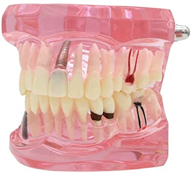 Dentalmall 1 st tandimplantat studie analys demonstration tänder modell #2001 med restaurering rosa