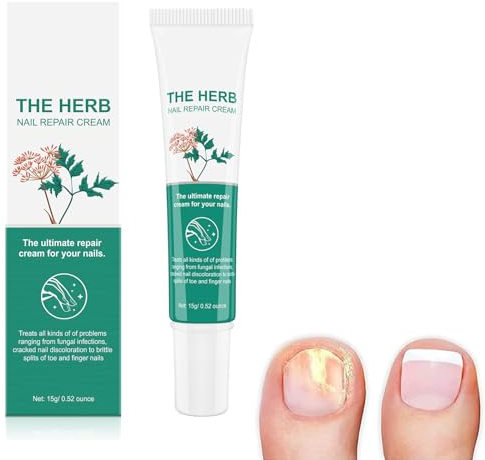 Mycose Ongles Des Pieds, Ongle Mycose Traitement, Mycose Pied, Mycose Pied Traitement, Traitement Mycose Pied, Traitement Des Ongles, Traitement Mycose Ongle Pied