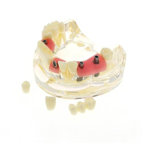 ERNZI Modèle De Dentaire des Dents De Pratiques Implant avec Implant Bridge Caries Enseignant Le Modèle De Dents pour Le Dentiste À Un Traitement Implantaire