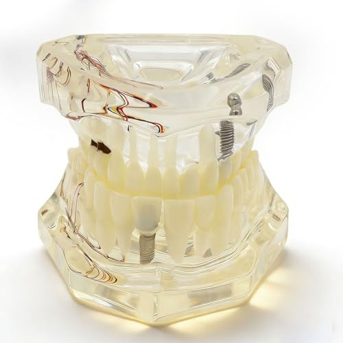 Modèle dentaire de réparation neurale, modèle pédagogique à dents amovibles pour les écoles dentaires, modèles anatomiques transparents pour l'enseignement de la pathologie